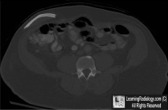Skull Flap from Craniectomy